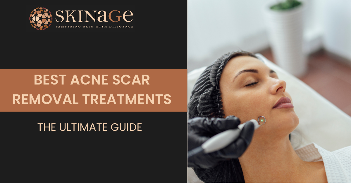Best Acne Scar Removal Treatments: The Ultimate Guide